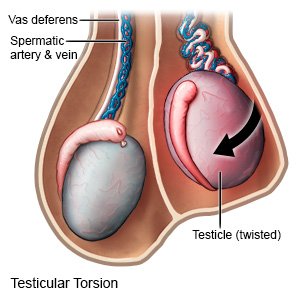 Does vasectomy increase the risk of torsion of the testicle No