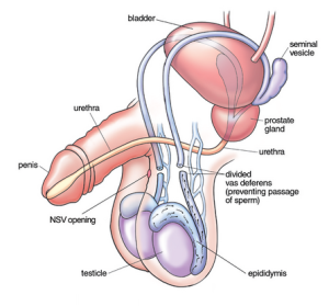 Image showing a drawing of a scrotum after vasectomy